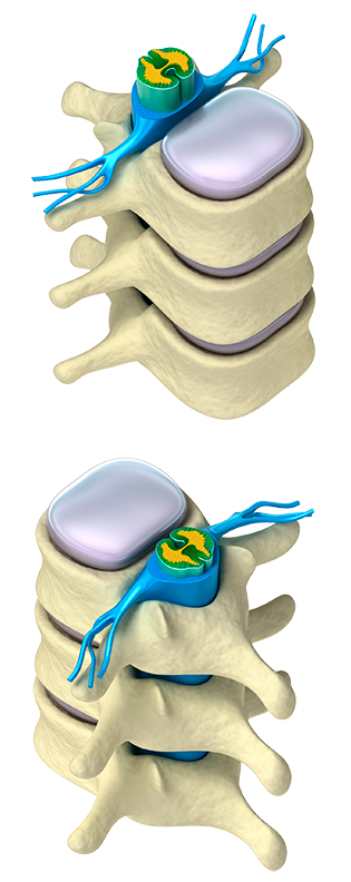 herniated disc relief herniated disc relief